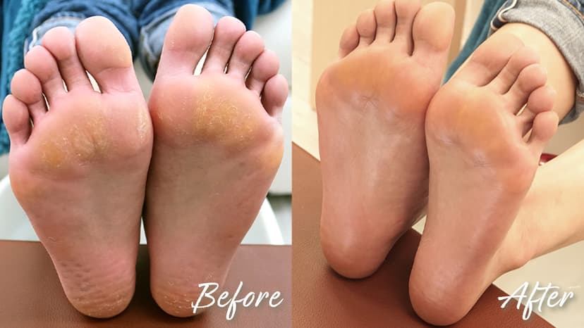 ドイツ式角質除去