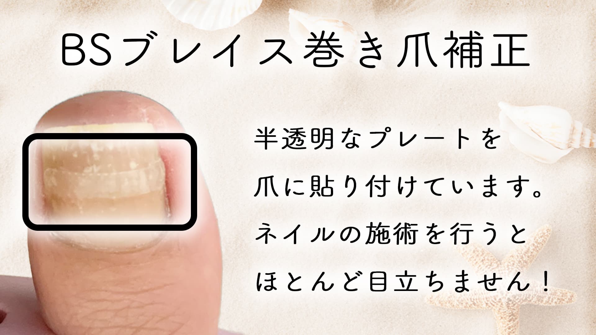 B/Sブレイス巻き爪補正